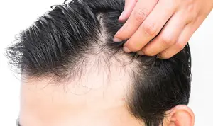 دلایل ریزش مو و روشهای مؤثر برای پیشگیری و درمان آن