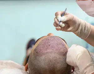 کاشت مو به روش تکثیری