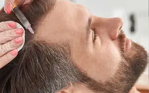 تاثیر مزوتراپی بر جلوگیری از ریزش مو