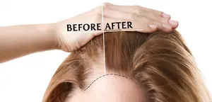 چگونه موهای کاشته شده را تقویت کنیم تا دائمی و سالم بمانند؟
