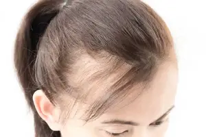 چگونه از ریزش مو جلوگیری کنیم؟ توصیه‌های پزشکی مهم