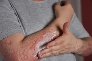 چگونه قارچ های پوستی را در مراحل اولیه تشخیص دهیم؟