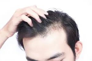 بهترین فصل کاشت مو