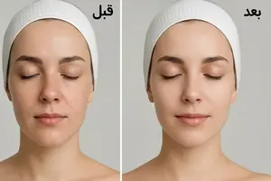 عوارض مزوتراپی پوست و نحوه جلوگیری از آن‌ها