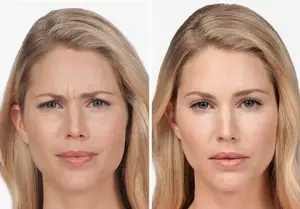 15 مزیت تزریق بوتاکس برای کاهش چین و چروک‌های صورت + عکس