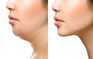 مراقبت های بعد از لیفت وصورت و گردن