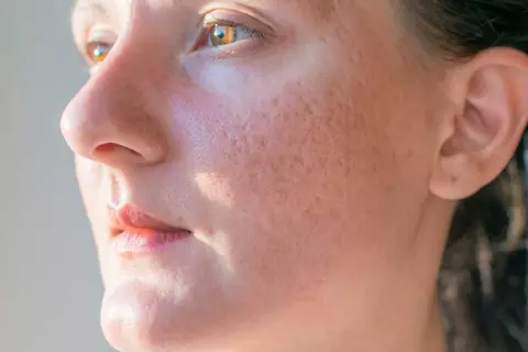 روش‌های از بین بردن لک و خال‌های پوستی بدون جراحی