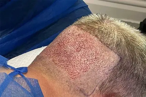 بهترین روش کاشت مو