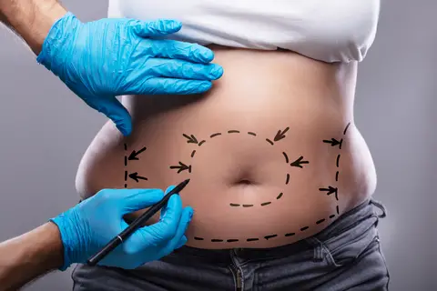 مراقبت های بعد از جراحی زیبایی شکم و پهلو