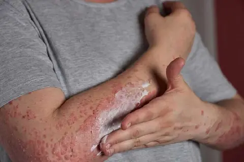 چگونه قارچ‌ های پوستی را در مراحل اولیه تشخیص دهیم؟