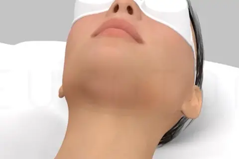 مزایای اندولیفت برای جوانسازی پوست نواحی مختلف بدن