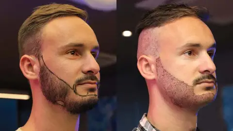 دوره نقاهت کاشت ریش