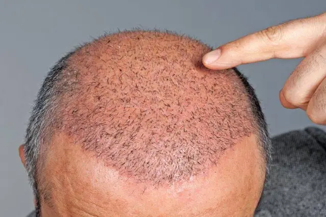 بهترین سن کاشت مو