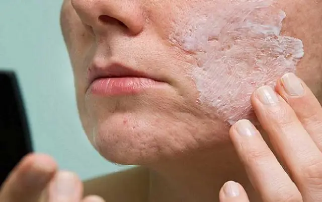 معرفی انواع جوش و جای جوش و پمادهای ملایم ترمیم كنندهی جای جوش