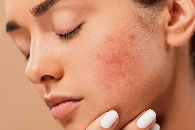معرفی درمانهای نوین برای بهبود عارضههای پوستی رایج