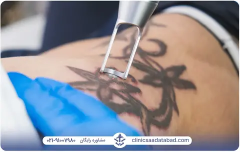 لیزر موهای زائد روی تاتو بدن زنان
