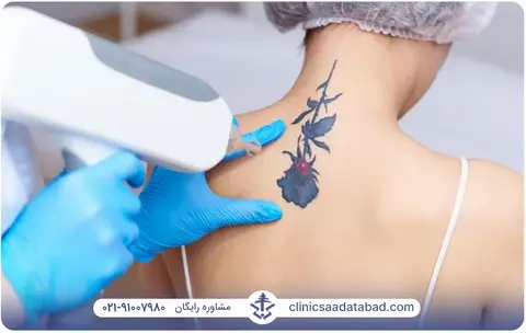 لیزر موهای زائد روی تاتو بدن زنان