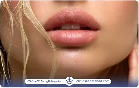تزریق ژل لب