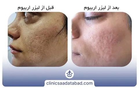 تصاویر قبل و بعد لیزر اربیوم