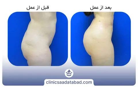 تزریق چربی به باسن