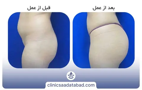 تزریق چربی به باسن