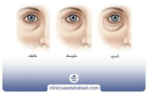 فیلر زير چشم