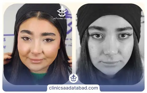 تزریق چربی