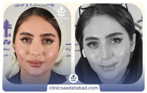 تزریق چربی