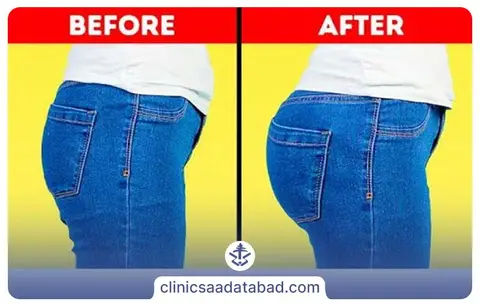تزریق چربی به باسن