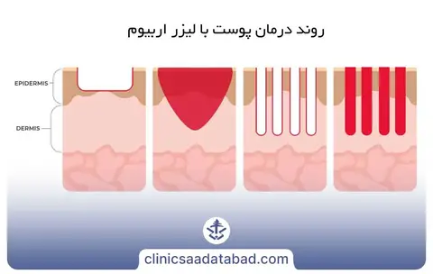 خدمات لیزر لیزر اربیوم
