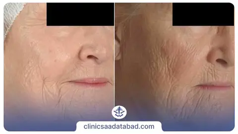 عکس قبل و بعد میکرودرم