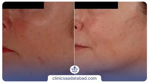 عکس قبل و بعد میکرودرم