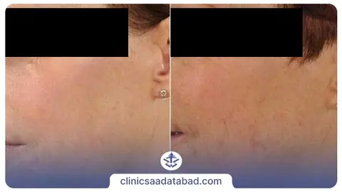 عکس قبل و بعد میکرودرم