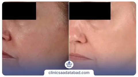 عکس قبل و بعد میکرودرم