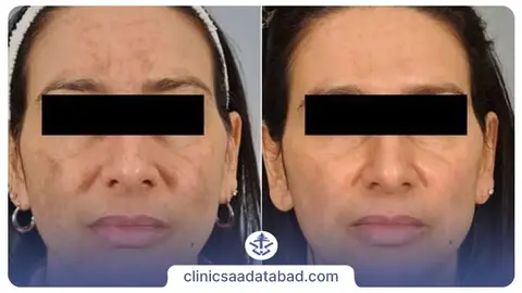 عکس قبل و بعد میکرودرم