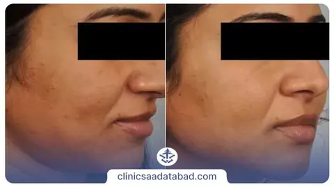 عکس قبل و بعد میکرودرم