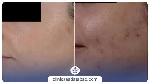 عکس قبل و بعد میکرودرم