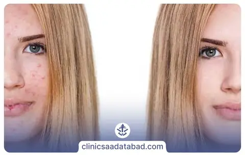 آکنه چگونه پدید می آید؟