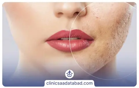آکنه چگونه پدید می آید؟