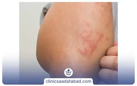 انواع قارچ&zwnj;های پوستی