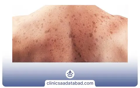 لک و خال های پوستی