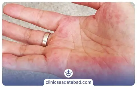 بیماری خود ایمنی لوپوس