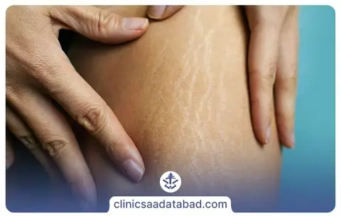 علت ایجاد سلولیت