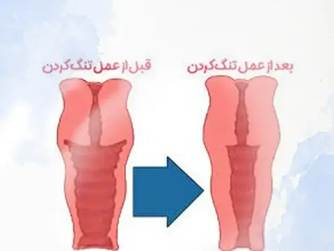 تنگ کردن واژن