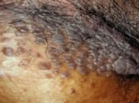 زگیل تناسلی
