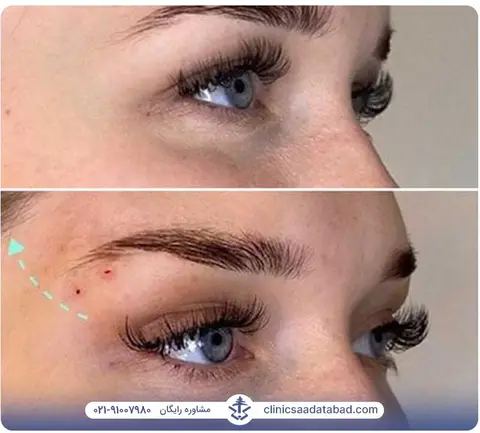 بوتاکس چشم گربه&zwnj;ای