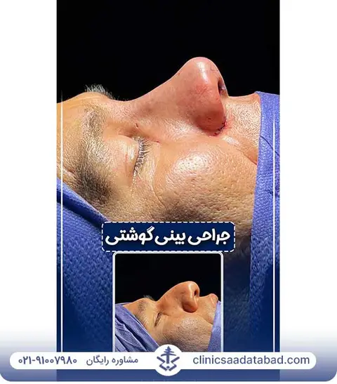 نمونه جراحی بینی رینوپلاستی