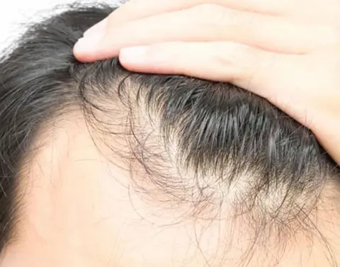 بهترین خط رویش کاشت مو