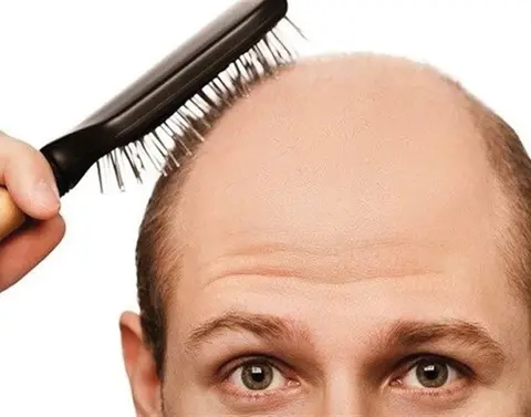 کاشت مو به روش تکثیری