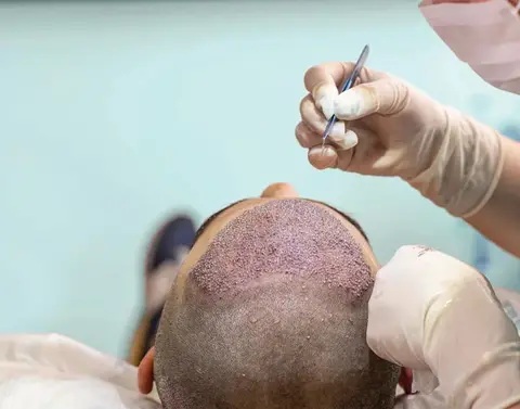 کاشت مو به روش تکثیری چیست